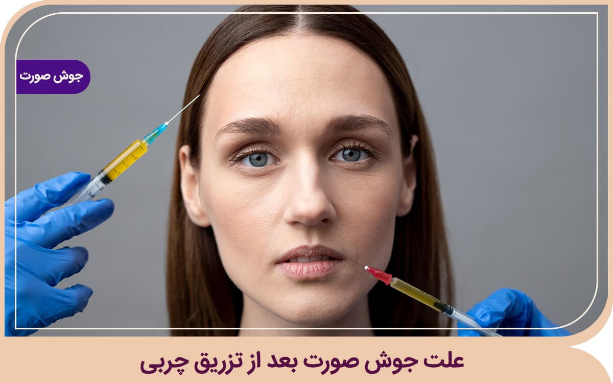 علت جوش صورت بعد از تزریق چربی