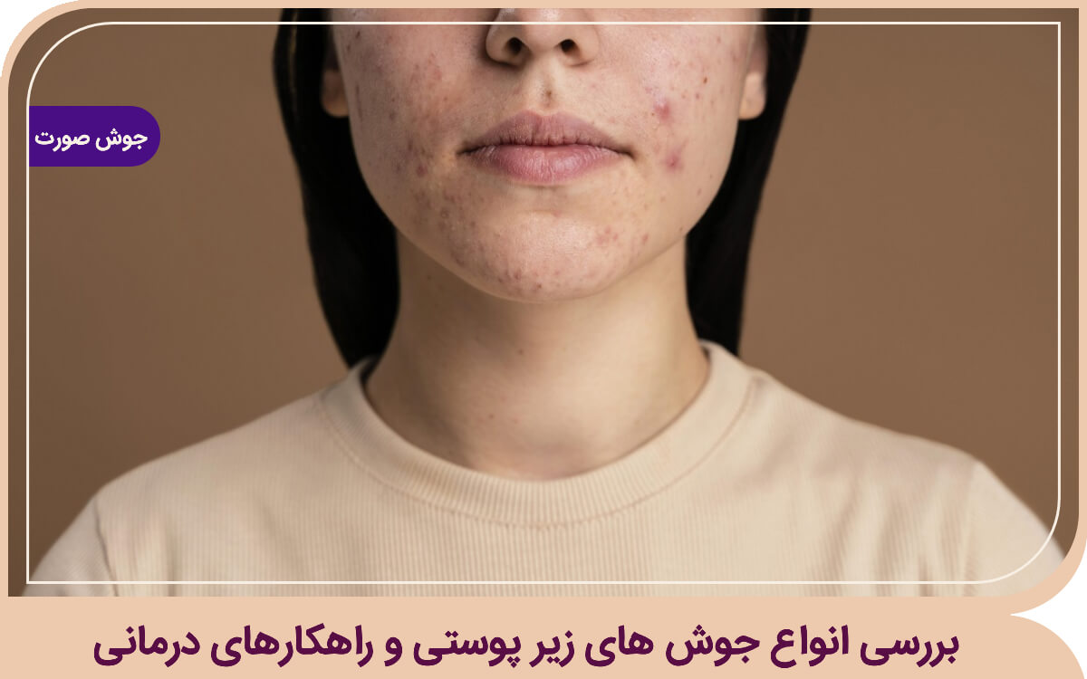 هر آنچه درباره جوش زیرپوستی باید بدانید