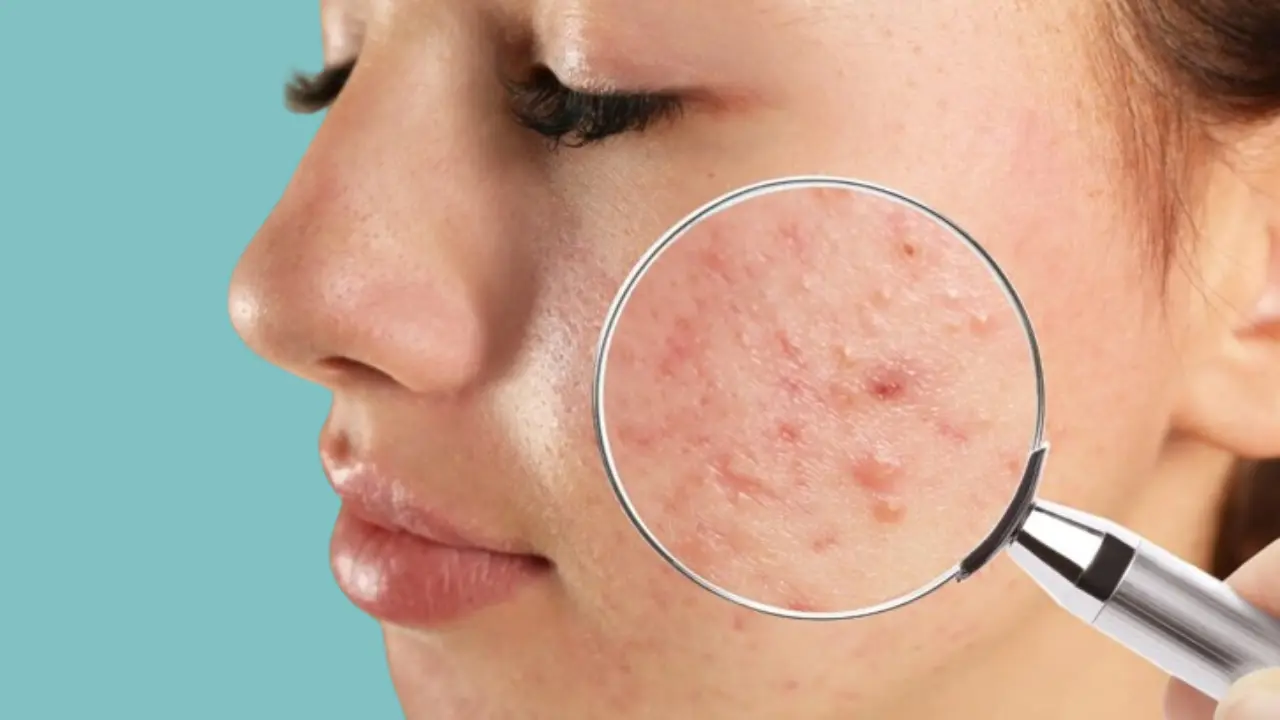آکنه ولگاریس صورت