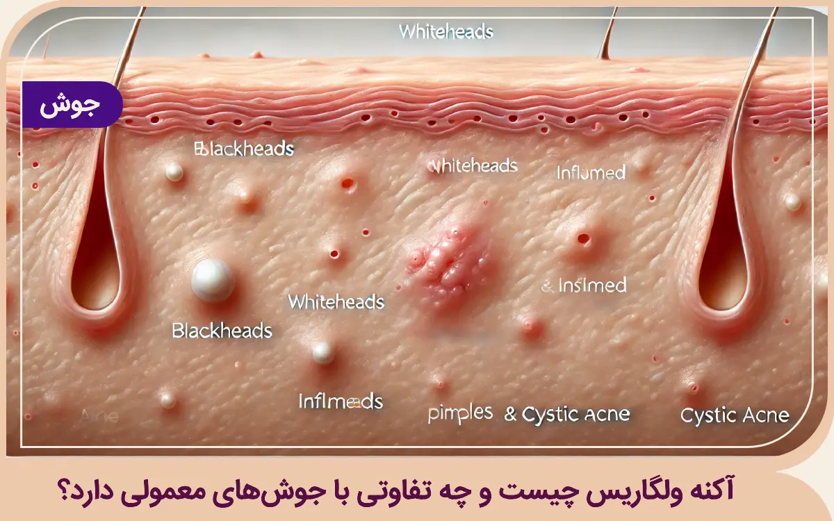 آکنه ولگاریس چیست و چه تفاوتی با جوشهای معمولی دارد؟ آکنه ولگاریس