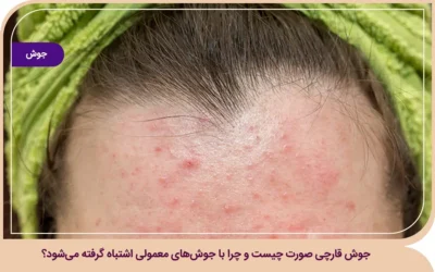 جوش قارچی صورت