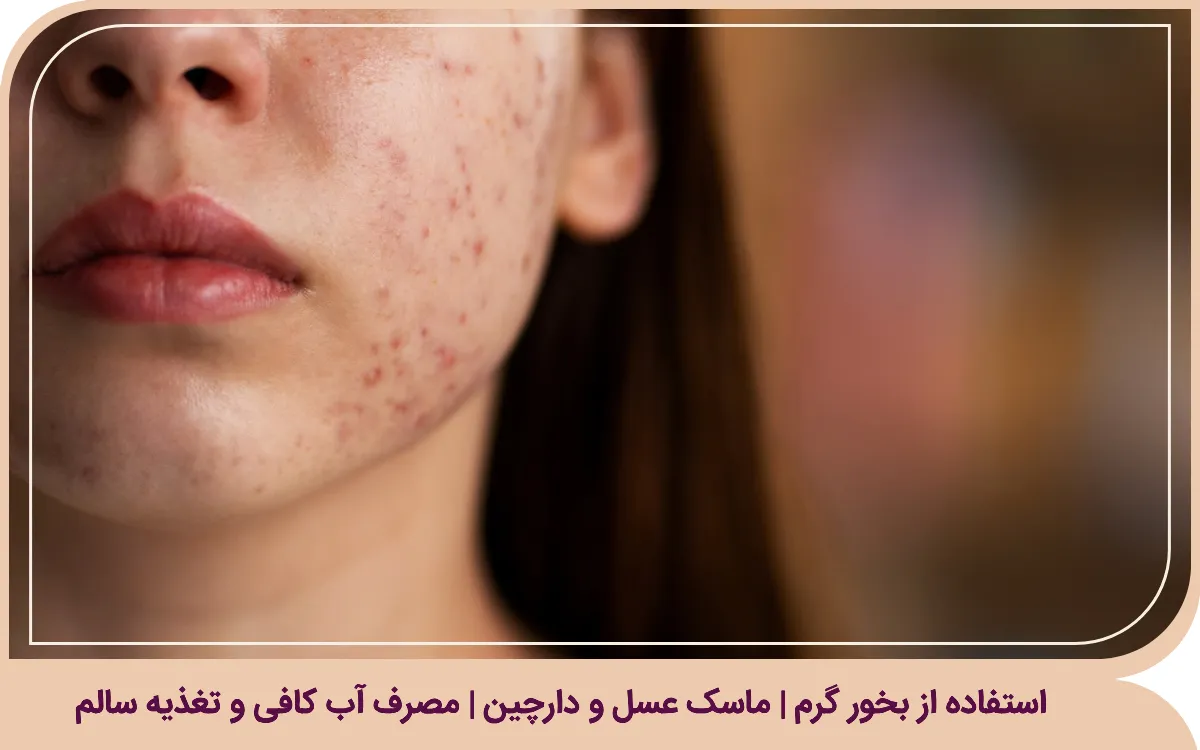 سه مورد از درمان خانگی جوش صورت برای نوجوانان