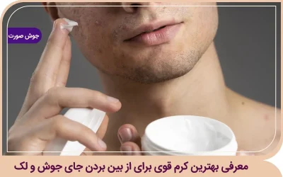کرم قوی برای از بین بردن جای جوش و لک