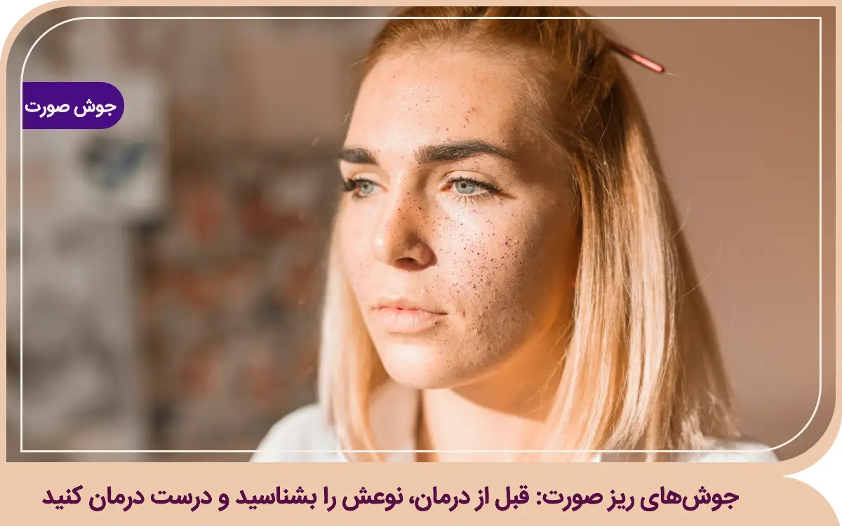 جوشهای ریز صورت: قبل از درمان، نوعش را بشناسید و درست درمان کنید جوش های ریز صورت