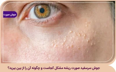 جوش سرسفید صورت