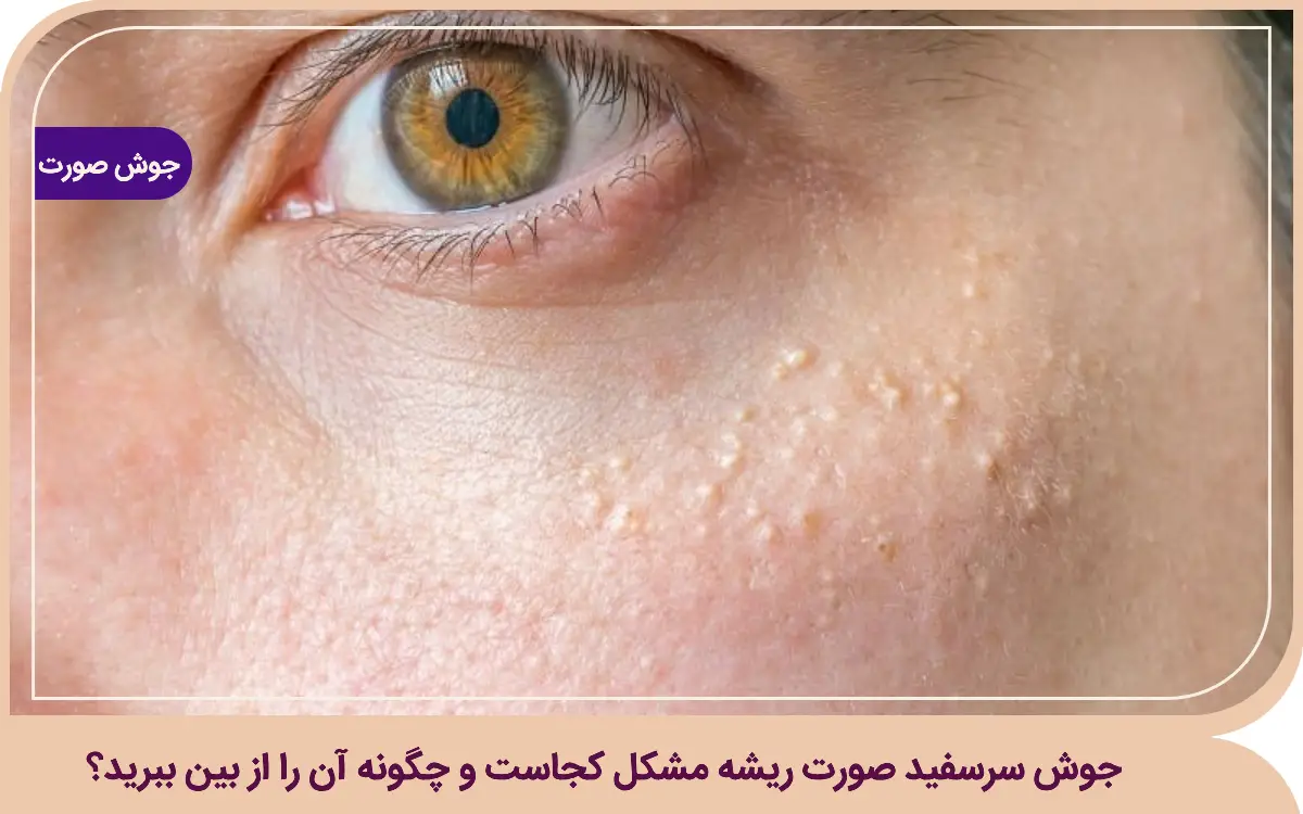 جوش سرسفید صورت