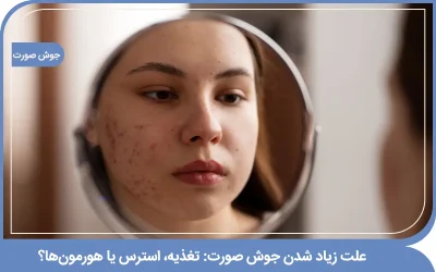 علت زیاد شدن جوش صورت