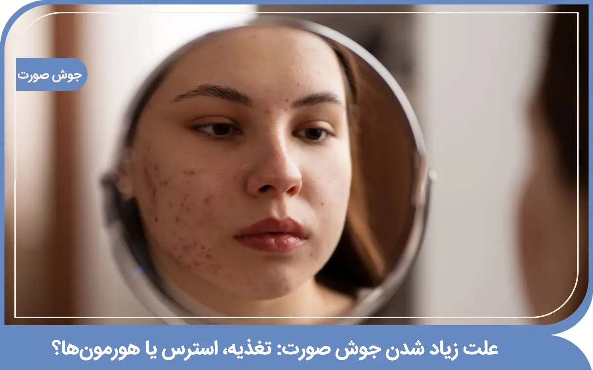 علت زیاد شدن جوش صورت