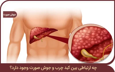 کبد چرب و جوش صورت