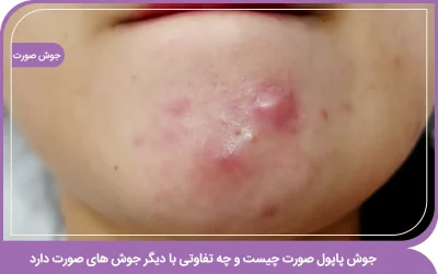 جوش پاپول صورت