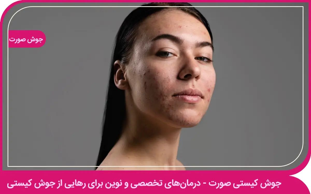 جوش کیستی صورت