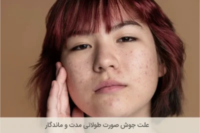 علت جوش صورت طولانی مدت