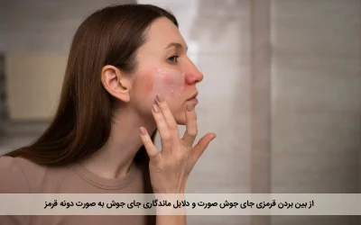 از بین بردن قرمزی جای جوش صورت